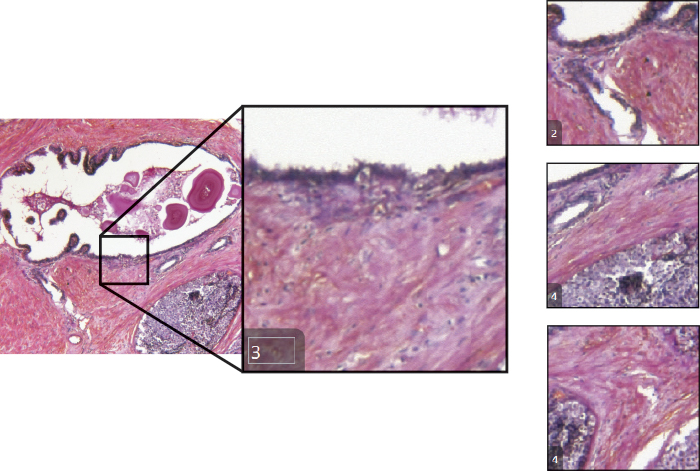 Life Sciences Gleason Cell Classification.jpg